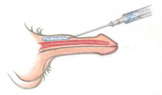 Objemová injekce kyseliny hyaluronové do penisu
